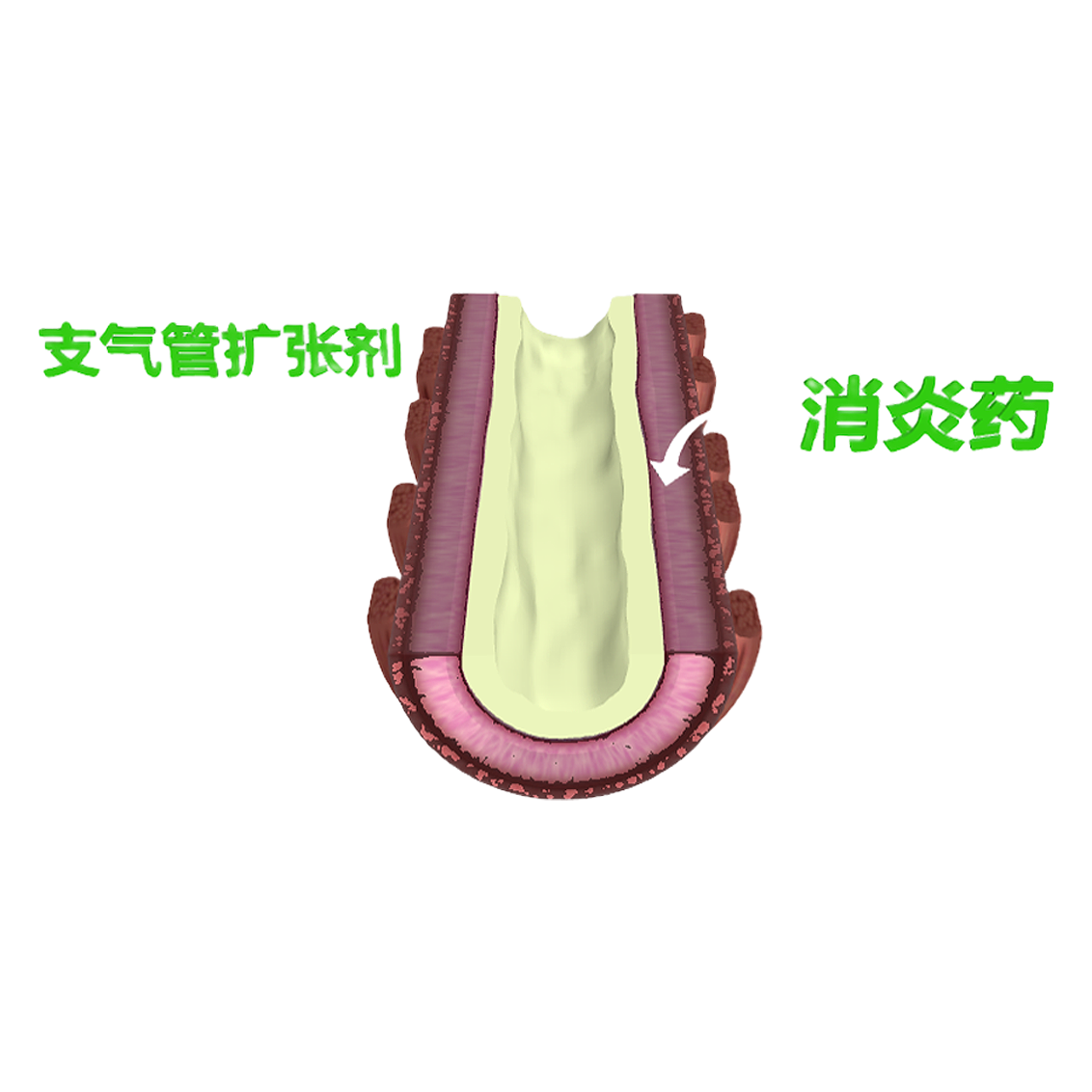 The treatment process of bronchitis (3D demonstration animation)