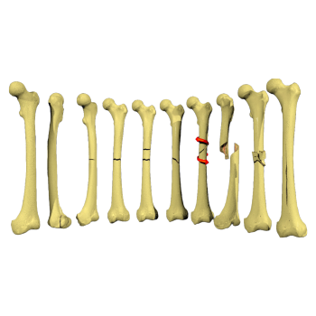 Pathological types of fractures