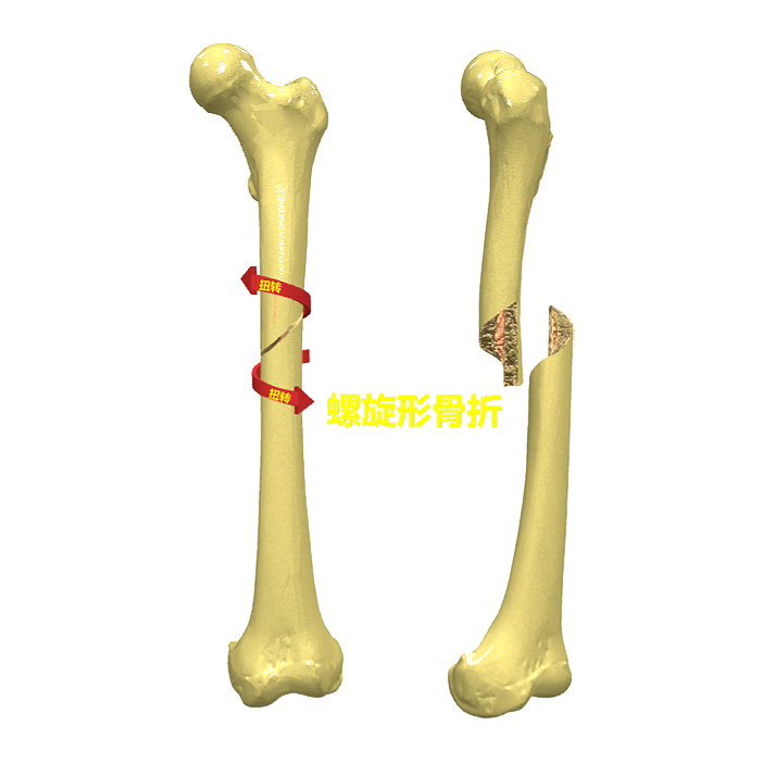 Spiral fracture (medical pathology 3D model)