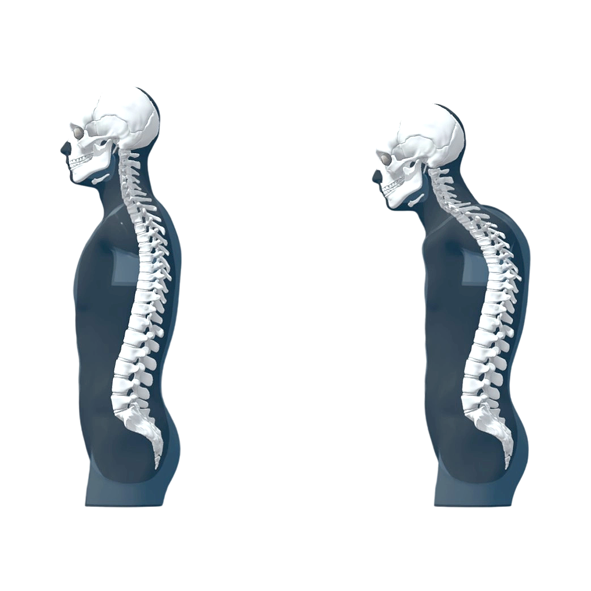 Medical comparison model of kyphosis and normal human spine