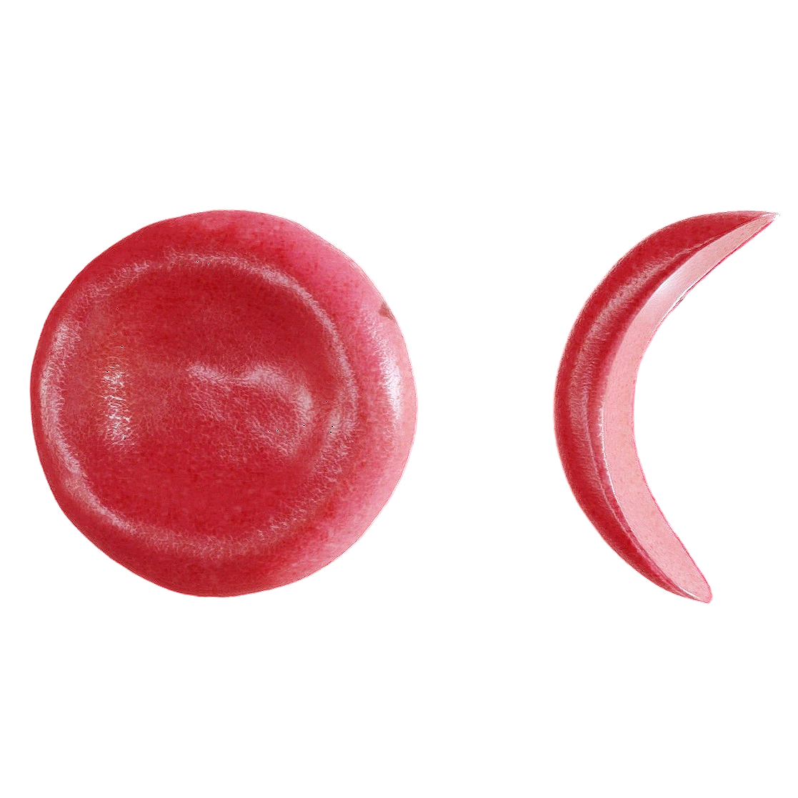 normal red blood cells versus sickle-shaped red blood cells